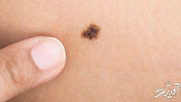 خال روی ران پا